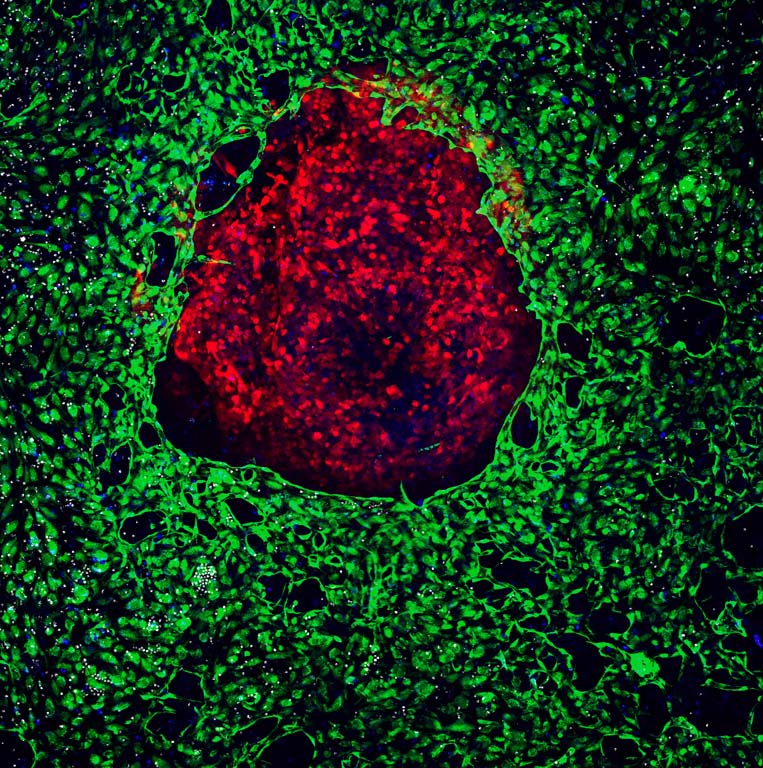 blood vessels and immune cells around a tumor