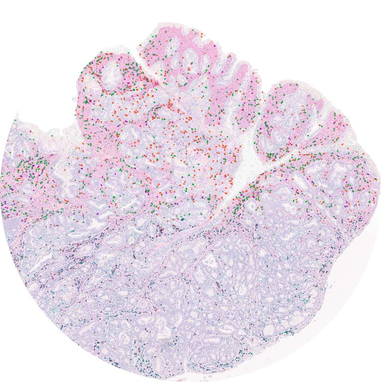 histological stain of immune cells in a tumor