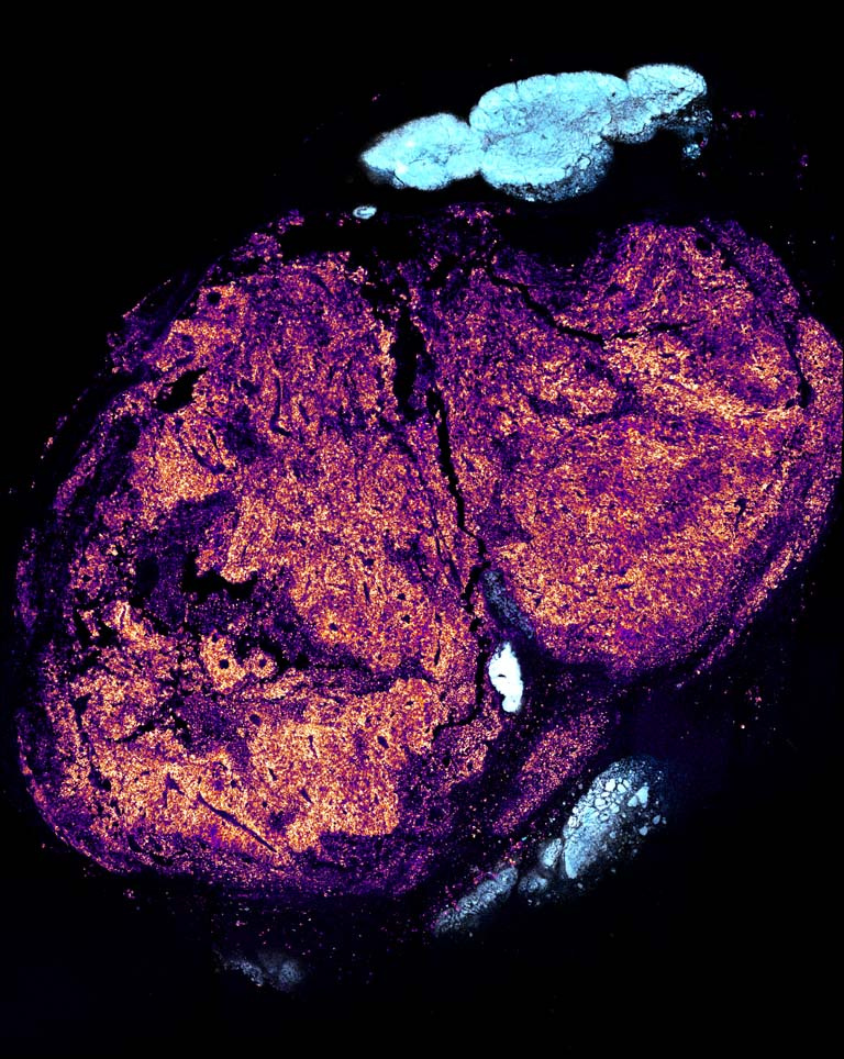 magenta molecules fluoresce in a tumor