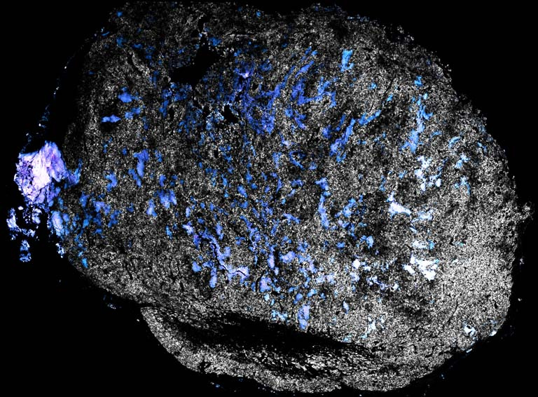 blue molecules in a grey tumor