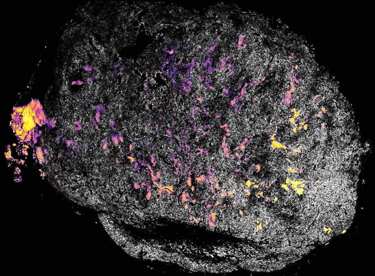 pink and yellow molecules in a grey tumor