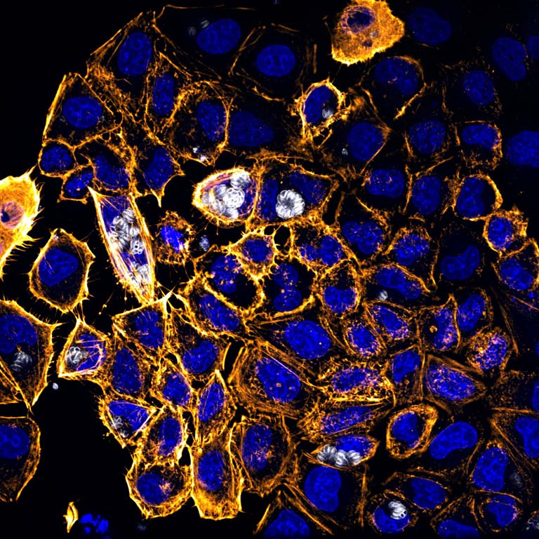 golden ringed nuclei, colored blue, cluster in a mass. The gold is more prominent in the cells on the left.