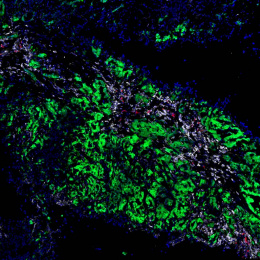 immune cells in a tumor