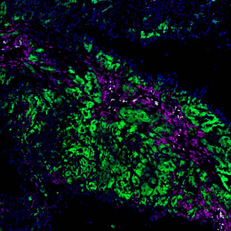 immune cells in a tumor