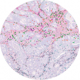 histological stain of immune cells in a tumor