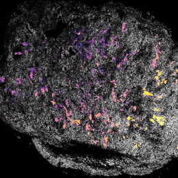 pink and yellow molecules in a grey tumor